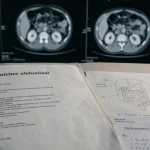 Peut-on voir un cancer avec un scanner abdominal : résultats de TDM abdominale