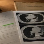 Poumon nodule : mesure sur scanner thoracique