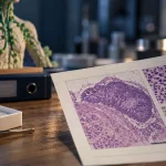 Cancer lymphatique : biopsie d’un ganglion persistant